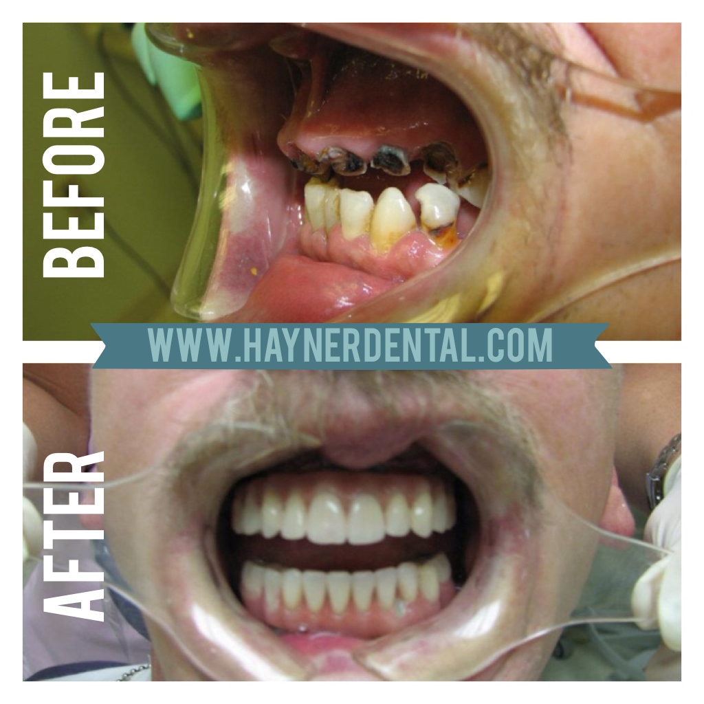 Preventing Tooth Decay (Cavities!) Hayner Dental