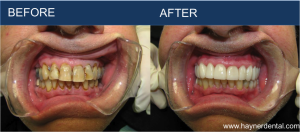 Restorative Dentistry – Before and After